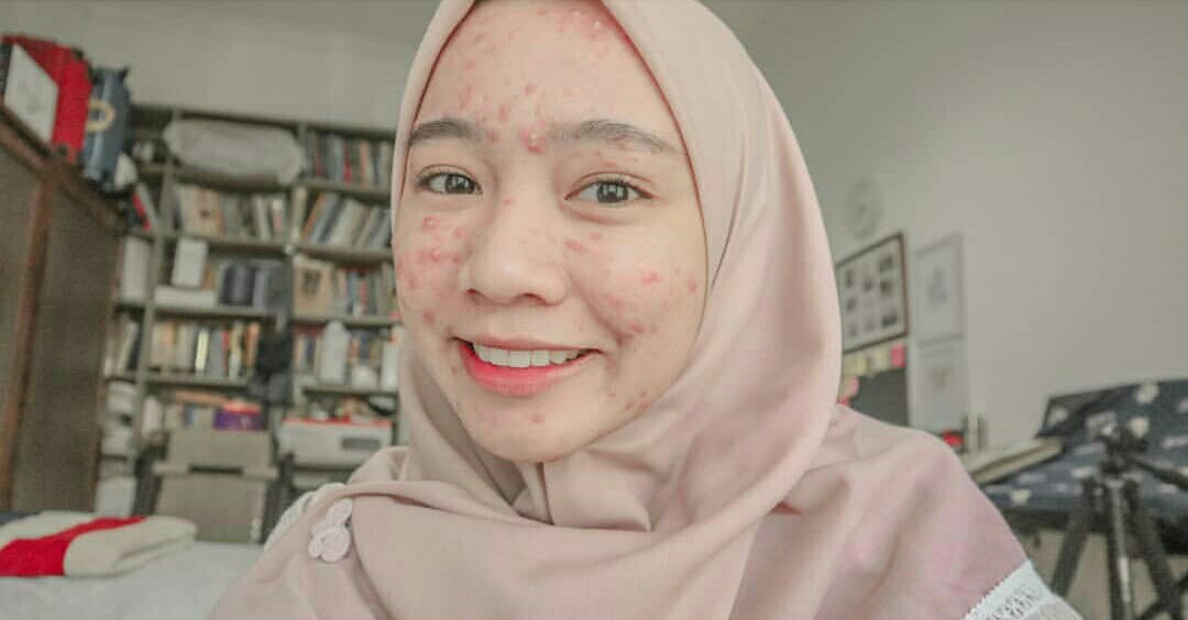 Bangga Wajah Berjerawat, Novia Ajak Mencintai Diri Sendiri